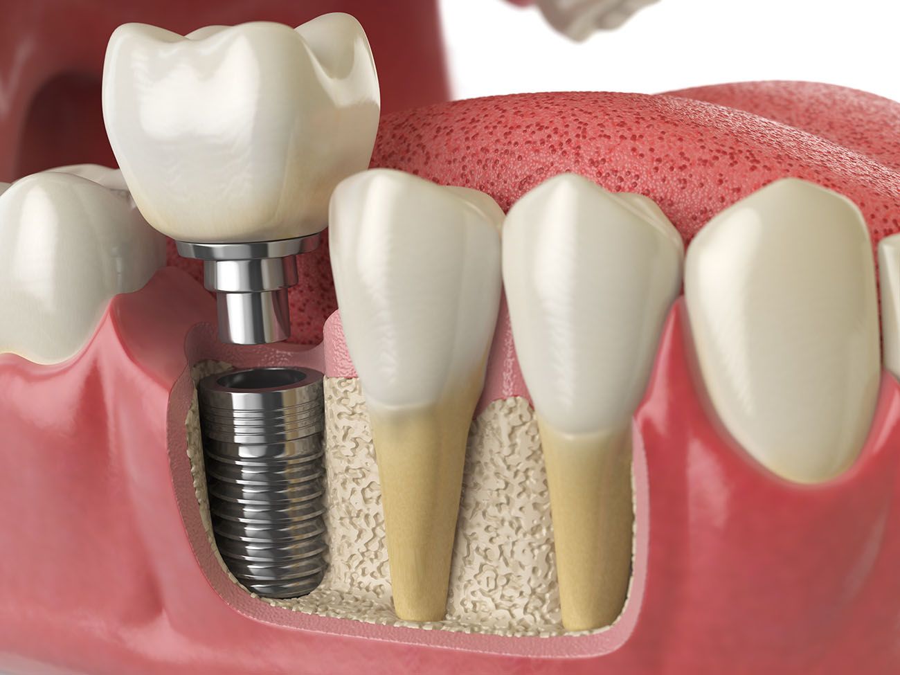 What Is A Dental Implant - Restorative Dentist In Gaithersburg, MD